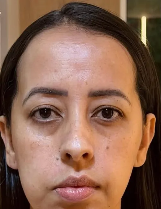 Antes do Full Face, frontal