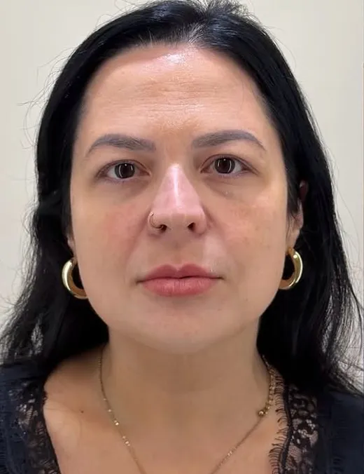 Antes do Full Face