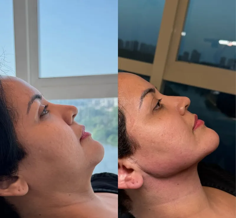 Antes e depois de tratamento do pescoço após emagrecimento