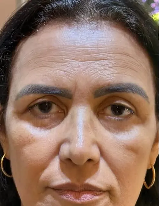 Antes do rejuvenescimento